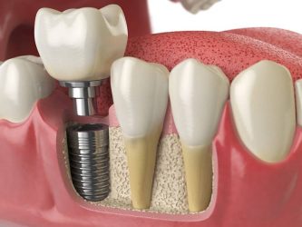 dental crown closeup
