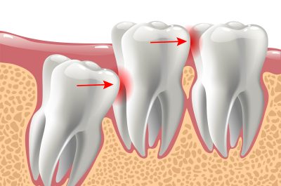 Wisdom Teeth (1 of 1) Wisdom Teeth (1 of 1)