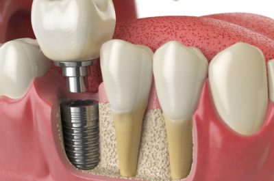 dental implants dental implants