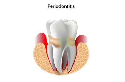 Periodontitis Tooth — Dental Care in Mittagong, NSW